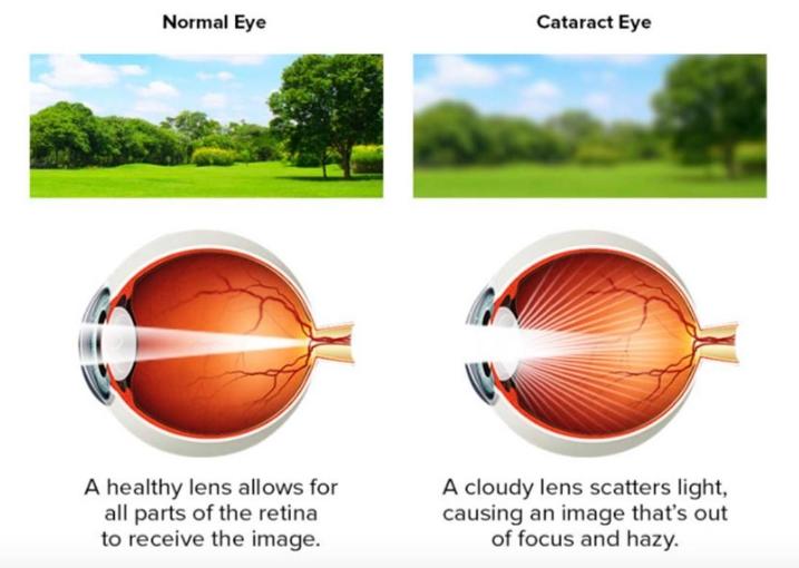It’s Cataract Awareness Month; Let’s Talk Cataract